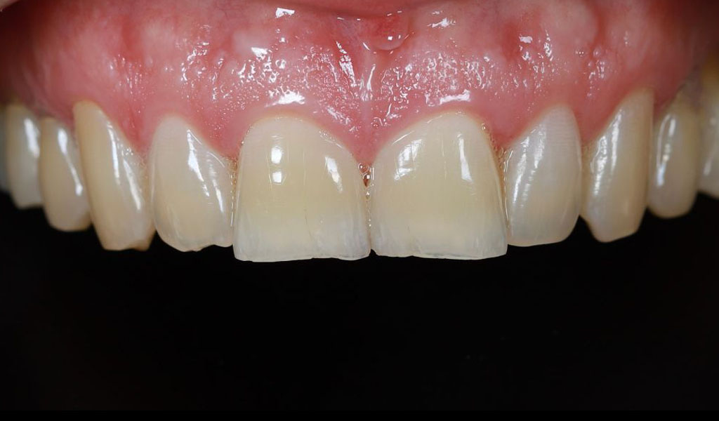Before